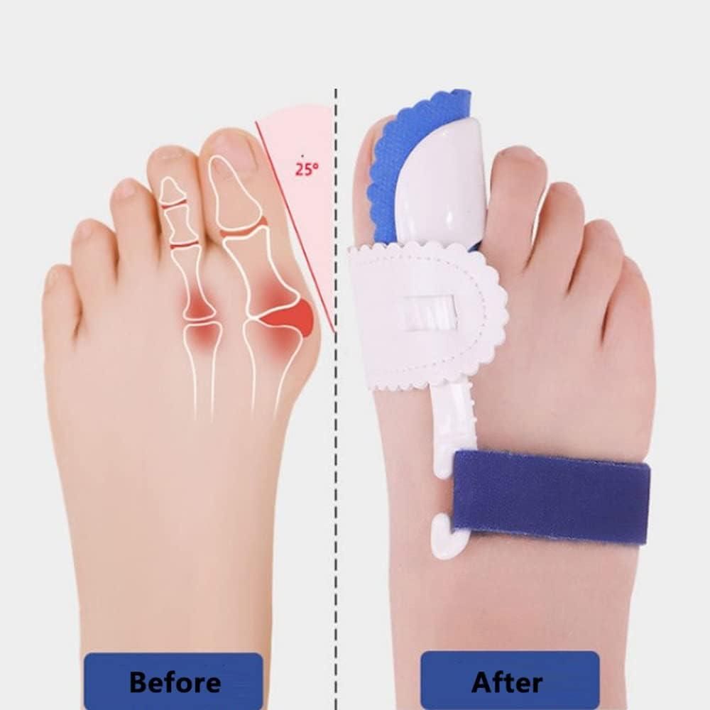 AlignEase™ Bunion Corrector Splint – Orthotic Toe Support (1 Pair)
