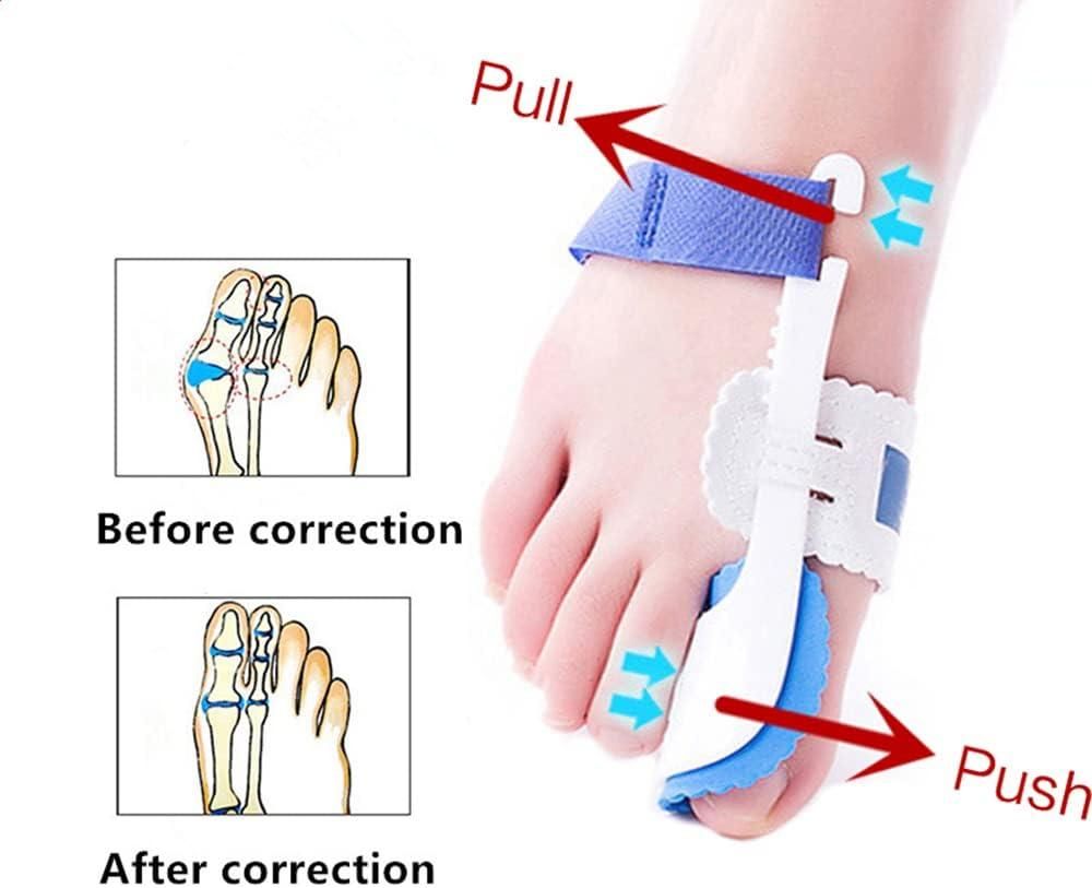 AlignEase™ Bunion Corrector Splint – Orthotic Toe Support (1 Pair)